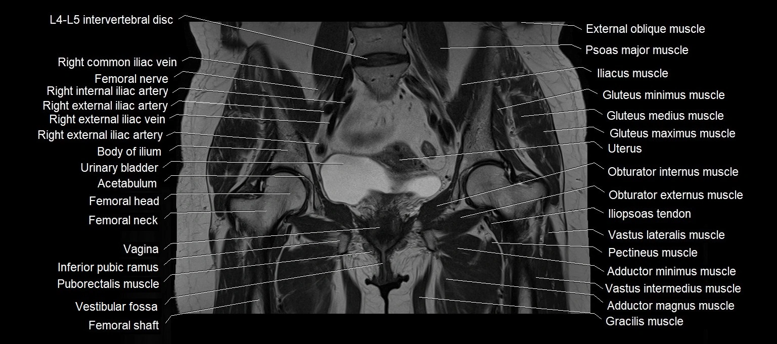 MRI 3T pelvis coronal cross section anatomy image 13.webp